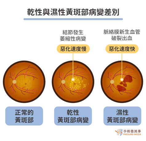 各種眼睛|青光眼、白內障、老年性黃斑點病變等：眼睛疾病以及。